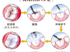 牙齿窝沟封闭费用