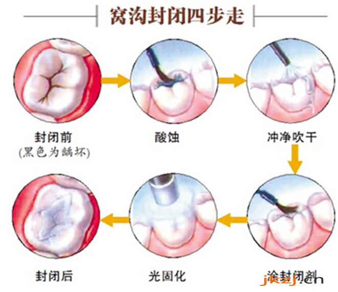 牙齿窝沟封闭多久做