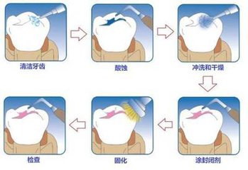 深圳做窝沟封闭多少钱