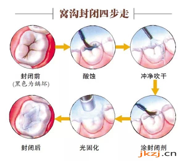 儿童窝沟封闭的价格