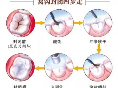 儿童窝沟封闭多少钱