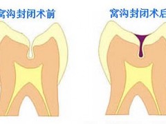 做窝沟封闭多少钱