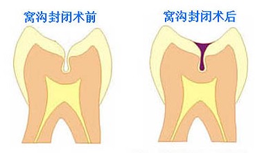 做窝沟封闭价格