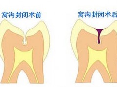 什么是窝沟封闭