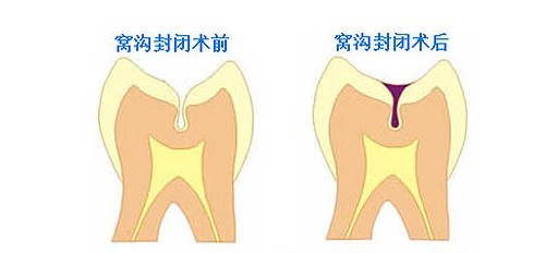 什么是窝沟封闭