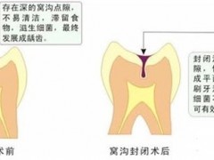 窝沟封闭什么时候做