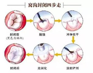 窝沟封闭几岁做好