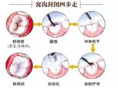 孩子几岁做窝沟封闭