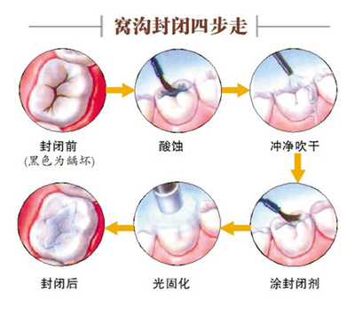 牙齿窝沟封闭的步骤