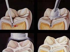 窝沟封闭和补牙有何区别