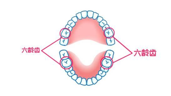 四颗六龄齿需要做窝沟封闭