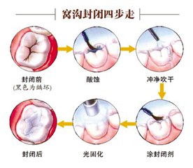 虎牙要做窝沟封闭吗