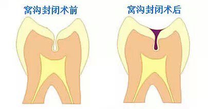 窝沟封闭的费用