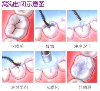 儿童蛀牙后做窝沟封闭有用吗