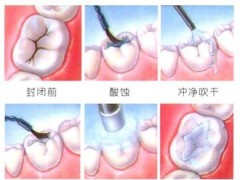 儿童蛀牙后还能做窝沟封闭吗