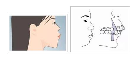 牙齿反颌、牙齿对脸型的影响到底有多大？