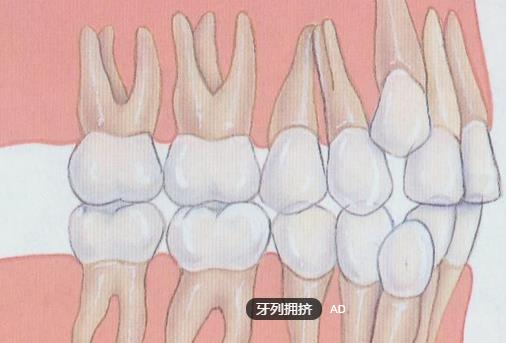 牙齿拥挤——笑容不自信