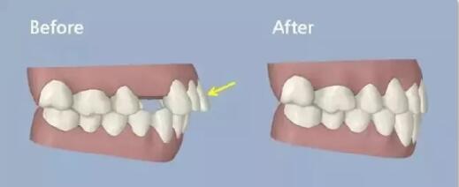 牙齿突矫正拔牙