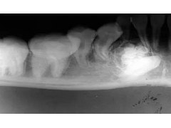 牙齿松动？可能是牙源性钙化上皮瘤的信号