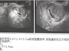 31岁年轻女性怀孕后异常阴道流血，结果竟是葡萄胎!