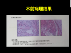 成釉细胞瘤复发？下颌骨缺损重建及功能性重建术效果好