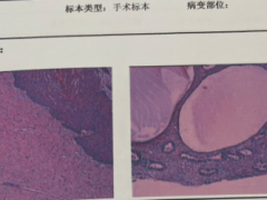 反复出现子宫脱垂，根治性手术治疗后痊愈！