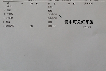 大便隐血阳性化验单结果图