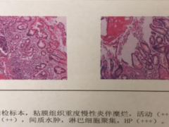 感染幽门螺杆菌，艾普拉唑肠溶片四联药物治疗很关键！