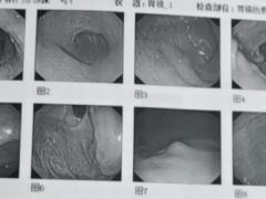 长期腹痛、腹胀，当心是乙状结肠与直肠息肉！