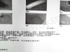 慢性胃炎怎么办？中西医结合治疗疗效好