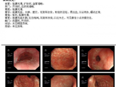 慢性萎缩性胃炎如何治疗,抑酸护黏膜很重要