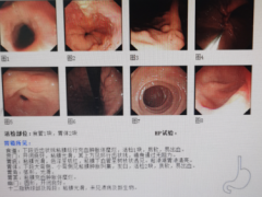 无缘无故出现腹胀表现，一定要警惕糜烂性胃炎