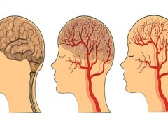 脑供血不足会引起痴呆吗？脑供血不足患者注意营养均衡