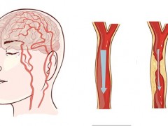 脑梗会导致说不出来话吗？如何预防脑梗死的发生